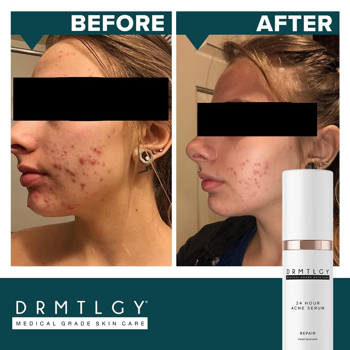 DRMTLGY® 24 HOUR ACNE SERUM